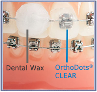 OrthoDots  CLEAR - pack of 4