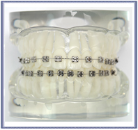 Consultation Models with Metal Brackets