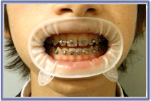 Optragate Small Disposable Lip and Cheek Retractors