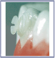 Bracket Bonder 10 Tips and Handle