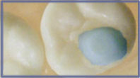 Molar Pad Bonder Tips + Handle