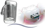 Roth** Molar Tubes - Single and Hook .022'' 