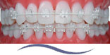 Tooth Coloured Stainless Steel Archwires