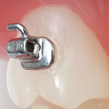 2nd Molar Bondable Tubes