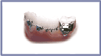 NT (Nickel Titanium) Molar Distalising Springs