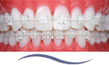Damon* TM Arch Compatible Super Elastic Nickel Titanium Tooth Coloured