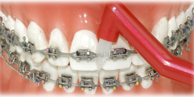 OrthoSpace Toothbrush V-Trim - Blue