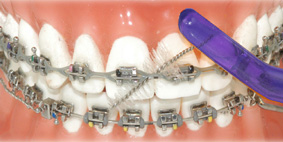 V2 Double Ended Orthodontic Toothbrush - Blue