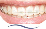 Euroform® Cosmetic Natural Tooth Coloured Archwires