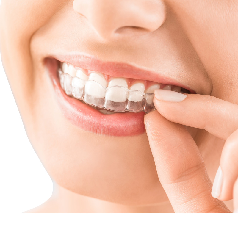 Excel� Plastic
 Aligner and Retainer Material