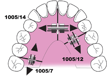 Expansion Screw 6mm