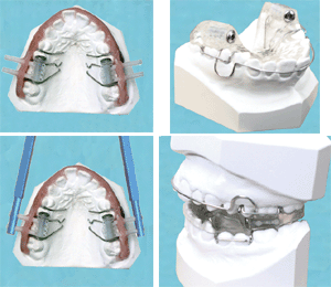 Clark Twin Block Chairside Advancement Kit