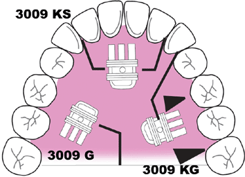 Plastic Bodied Expansion Screw 7.5mm - Mandible