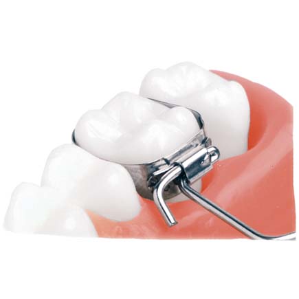 Lingual Sheaths for Palatal Arches