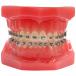 Typodont with Glory II Self Ligating Brackets - view 1