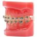 Typodont with Glory II Self Ligating Brackets - view 2