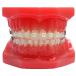 Typodont with Self Ligating Ceramic brackets - view 1