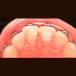 CERAMIC BITE BUMPER BB-00-01 - view 3