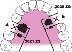 Traction Screws 